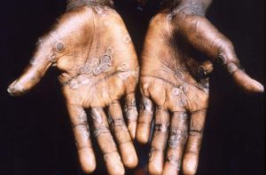 Nigeria: six monkeypox cases recorded in May