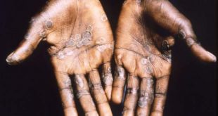 Nigeria: six monkeypox cases recorded in May
