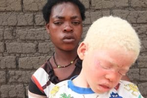 Malawi: man jailed for life for murder of brother with albinism