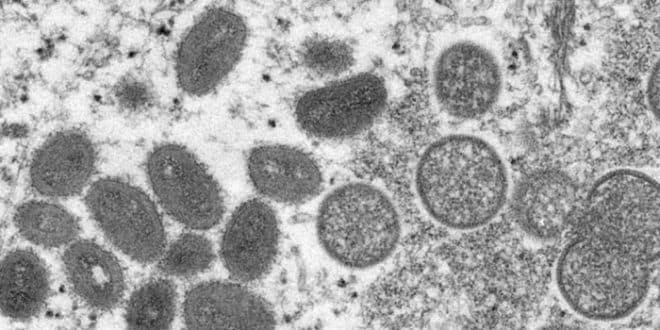 Health: New York calls for new name for monkeypox