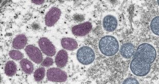 Health: Ghana confirms first death from monkeypox