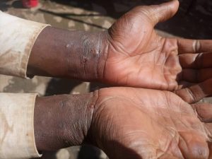 Thousands affected by scabies in eastern Uganda