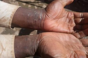 Thousands affected by scabies in eastern Uganda