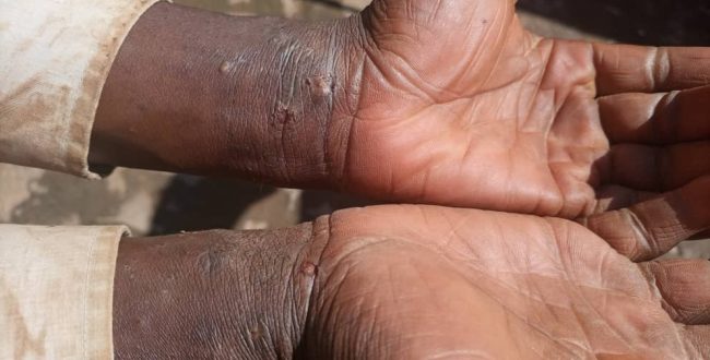 Thousands affected by scabies in eastern Uganda