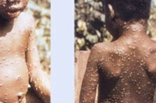 Several deaths and 116 cases of Monkeypox recorded in Ghana