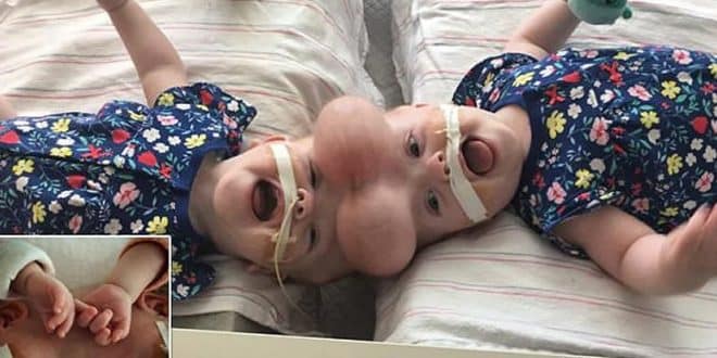 Hospital performs successful surgery on Siamese twin