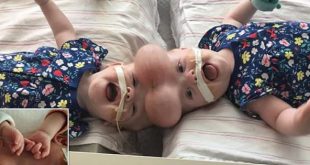 Hospital performs successful surgery on Siamese twin
