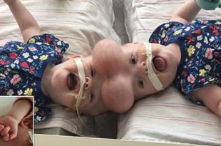 Hospital performs successful surgery on Siamese twin