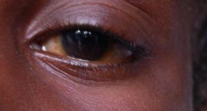 Mozambican goes blind after washing eyes with soap and urine