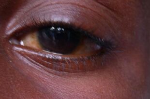 Mozambican goes blind after washing eyes with soap and urine