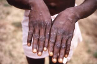 Uganda: two new cases of mpox confirmed