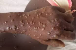 Mpox: the spread of the virus declines in Africa