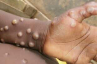 Monkeypox makes a comeback