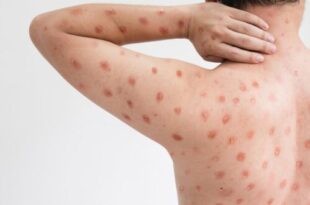 First case of monkeypox confirmed in Morocco
