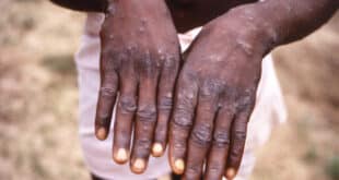 Ghana: 2 cases of Mpox in Accra